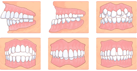 歯列矯正の症例